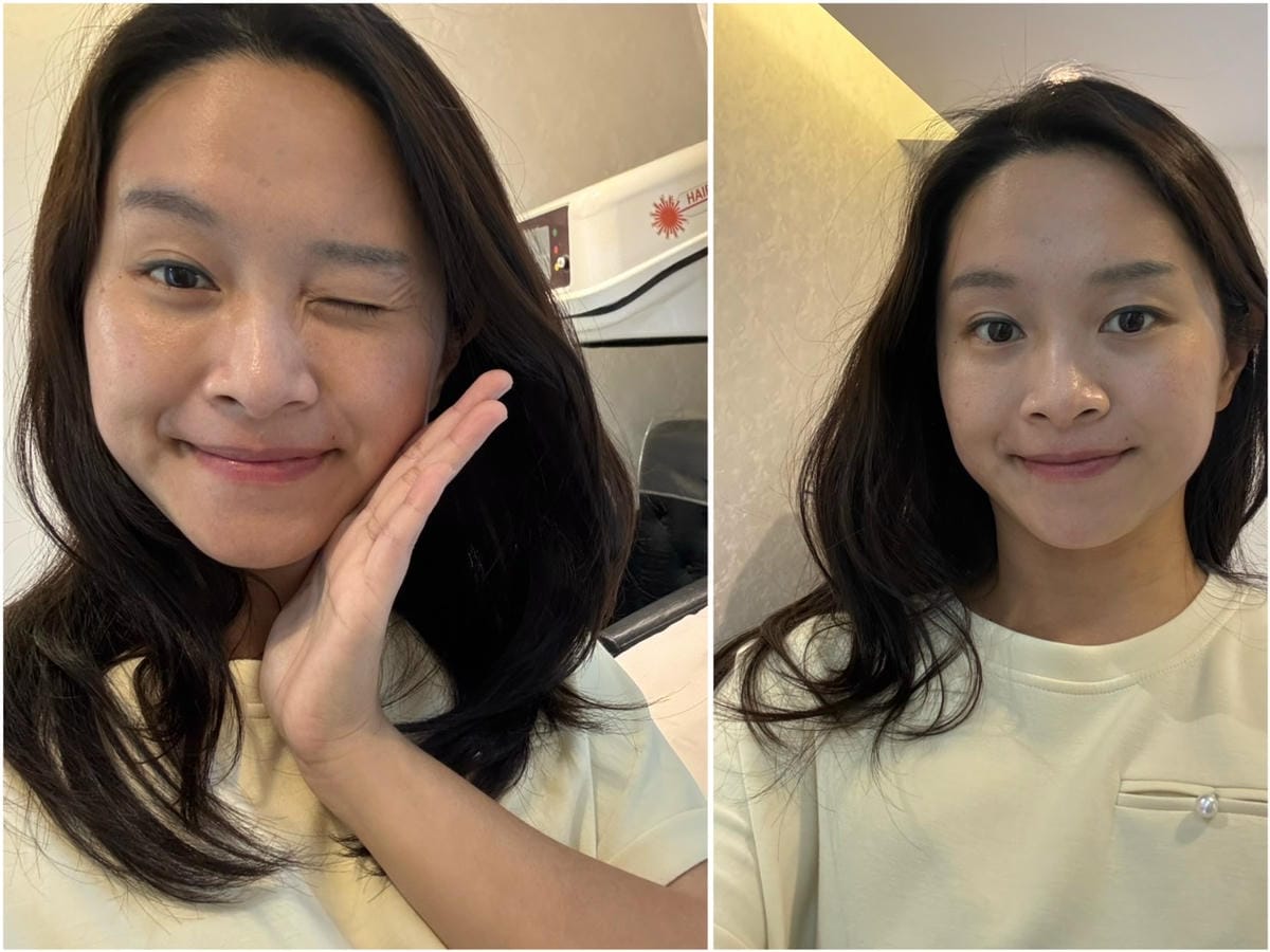 [美] 輕熟齡緊實拉提.ᐟ 愛爾麗診所 龍捲風音波拉提 無痛